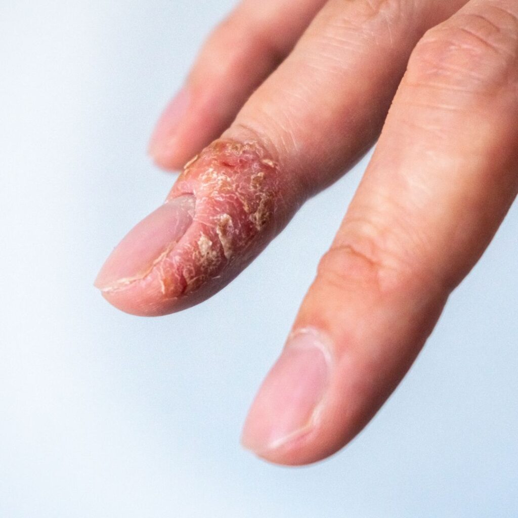Contact Dermatitis on the hand