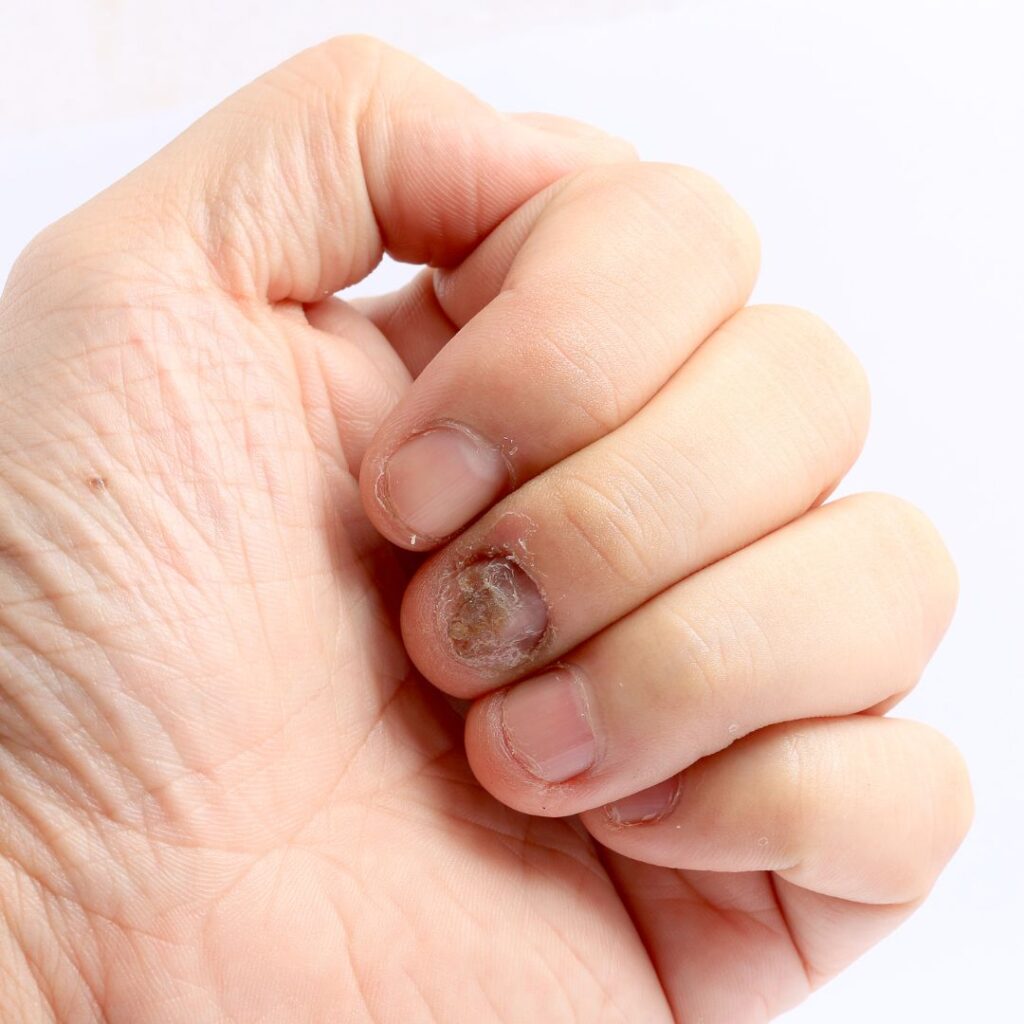 Fungal Infection on nail
