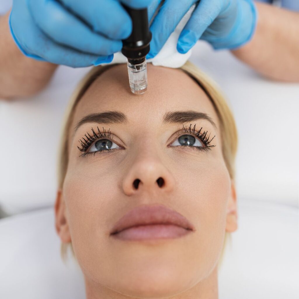 Microneedling on Face