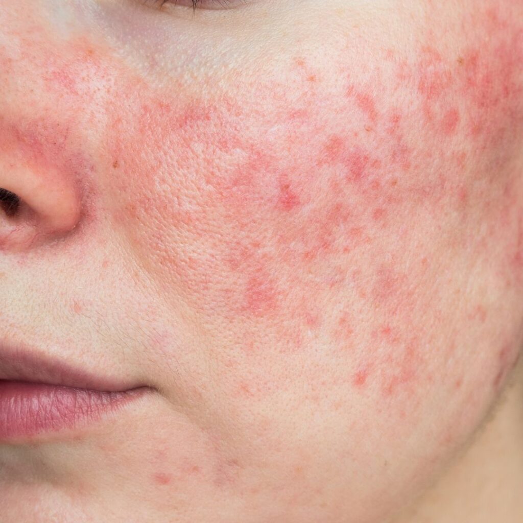 Rosacea Symptoms