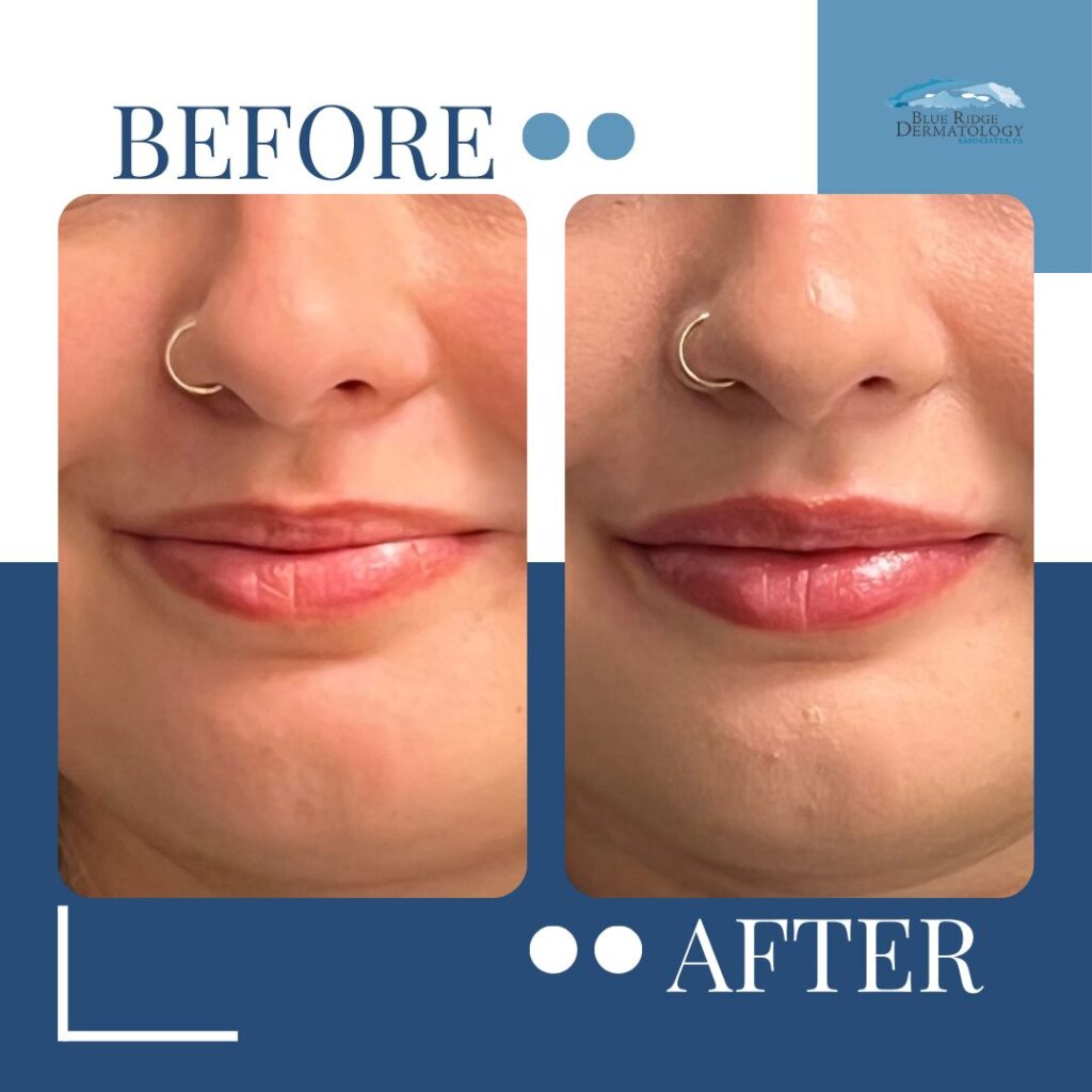 Before and After Lips